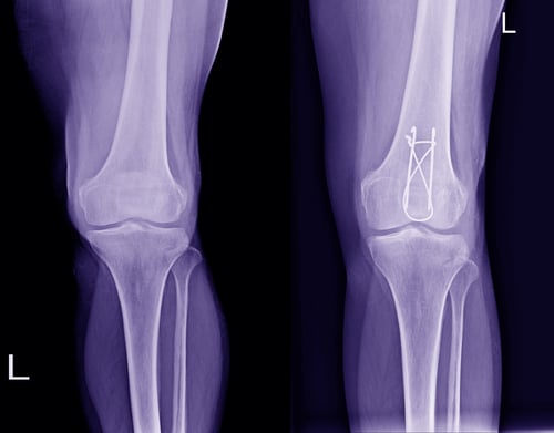 x ray showing a k-wire medical device