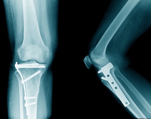  a cancellous screw in cancellous bones