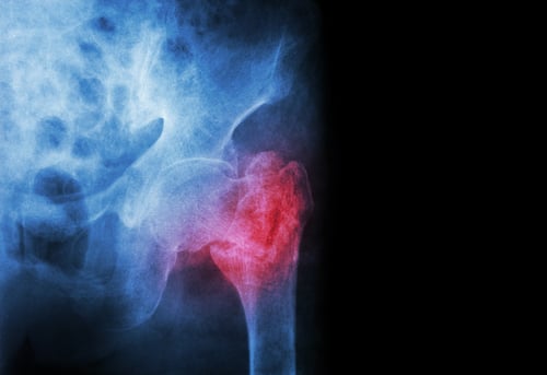x ray showing where a cannulated screw could be placed