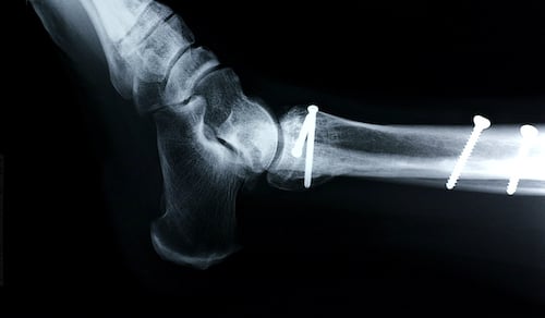x ray showing the placement of a cortical screw in a cortical bone